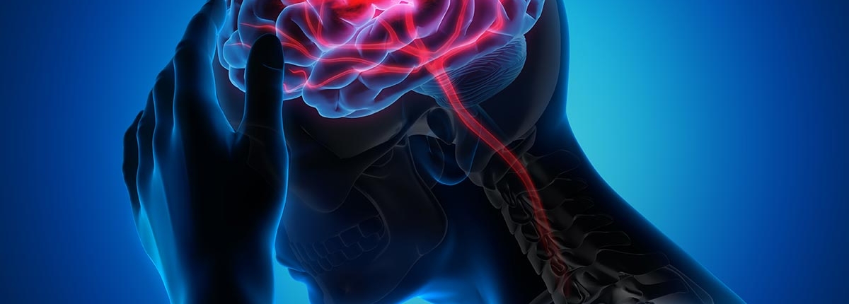 An illustration of a stroke happening in the brain