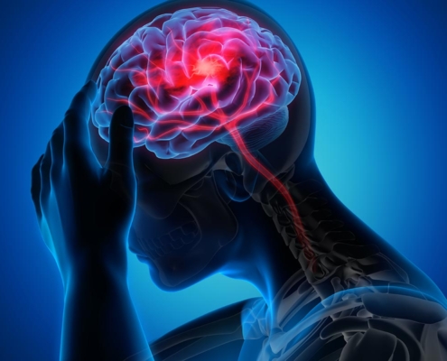 An illustration of a stroke happening in the brain